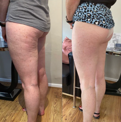 Lumera Cellulite Massager™