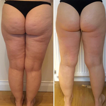 Lumera Cellulite Massager™