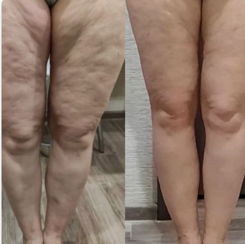 Lumera Cellulite Massager™